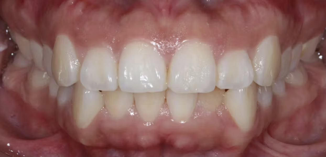 Xác định vị trí đường viền nướu trong thiết kế nụ cười nha khoa